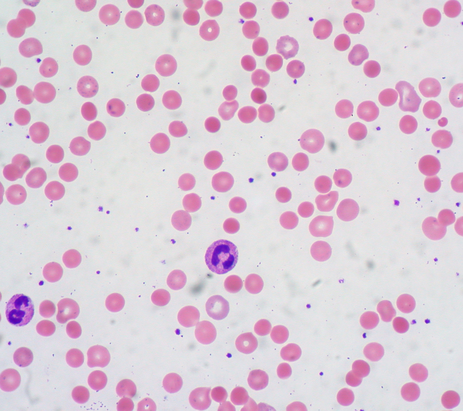 Warm_autoimmune_hemolytic_anemia. E. Uthman, MD, CC BY-SA 2.0